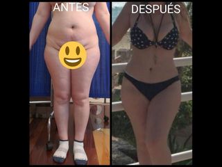 Antes y después de Abdominoplastia