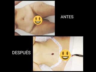 Antes y después de Abdominoplastia