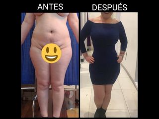 Antes y después de Abdominoplastia