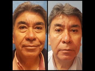 Antes y después de Blefaroplastia