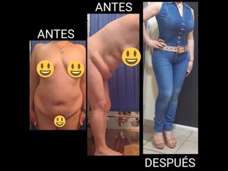 Antes y después de Abdominoplastia