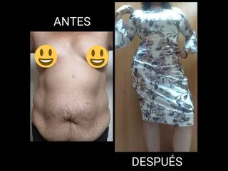 Antes y después de Abdominoplastia