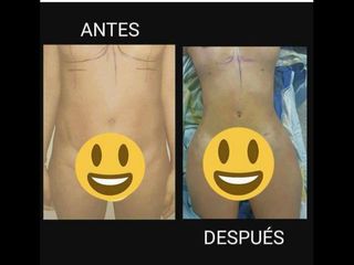 Antes y después de Lipoescultura