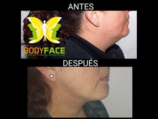 Antes y después de Lipo papada 