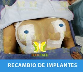 Recambio de implantes mamarios
