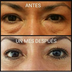 Antes y después de Blefaroplastia