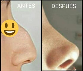 Antes y después de Rinoplastia