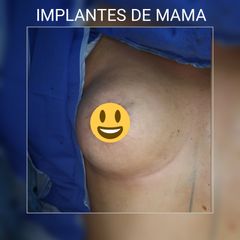 Implantes de mama