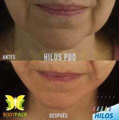 Antes y después de Hilos de sustentación borde madibular