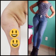 Antes y después de Liposucción