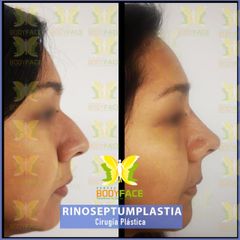 Antes y después de Rinoplastia