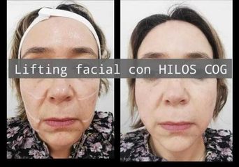 Hilos COG - Clínica Heal Aesthetics