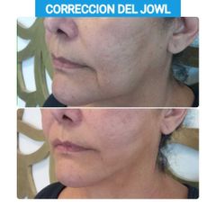 Jowls con hilos - Clínica Heal Aesthetics