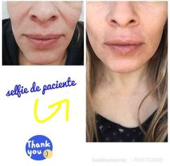 Lifting facial con hilos PDO - Clínica Heal Aesthetics