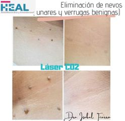 Eliminacion de Verrugas - Clínica Heal Aesthetics