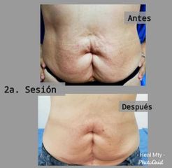 Remodelacion Corporal - Clínica Heal Aesthetics