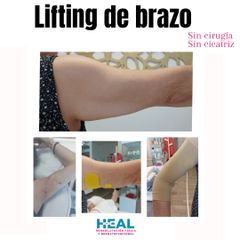 Lifting de brazos - Clínica Heal Aesthetics