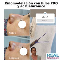 Rinomodelación  - Clínica Heal Aesthetics