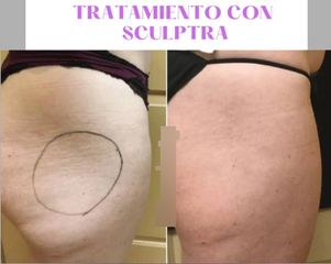 Sculptra glúteos - Clínica Heal Aesthetics