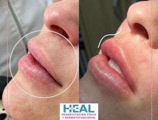 Aumento de labios - Clínica Heal Aesthetics