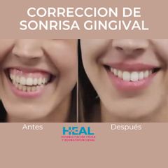 Sonrisa gingival - Clínica Heal Aesthetics