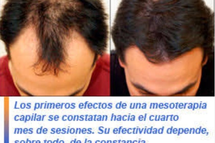 Alopecia antes y después - 555805