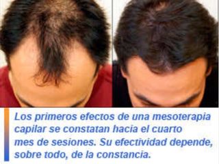 Antes y después de Alopecia