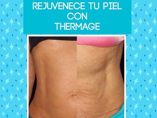 Thermage