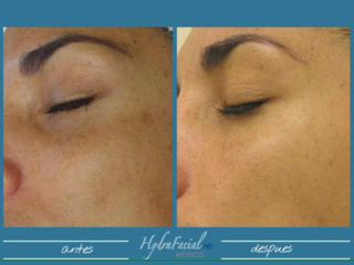 Hydrafacial