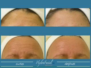 Hydrafacial