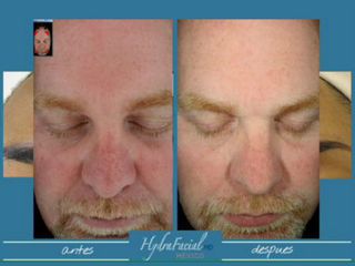 Hydrafacial