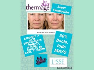 Flacidez con Thermage
