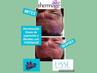 Líneas de Expresión con Thermage