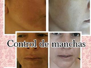 Antes y despues de control de manchas