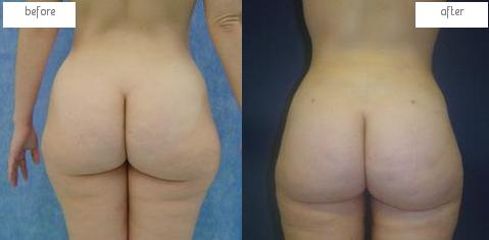 Antes y después Gluteoplastia