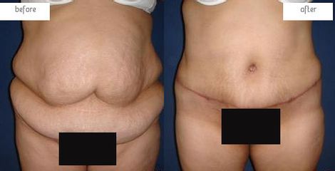Antes y después Abdominoplastia