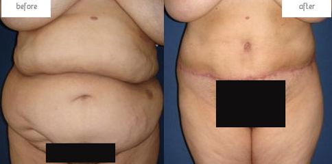 Antes y después Abdominoplastia