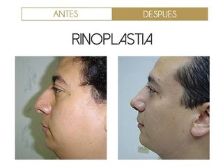 Antes y después Rinoplastia