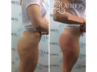 Antes y después de  Radiofrecuencia : Venus legacy, levantamiento de glúteos 