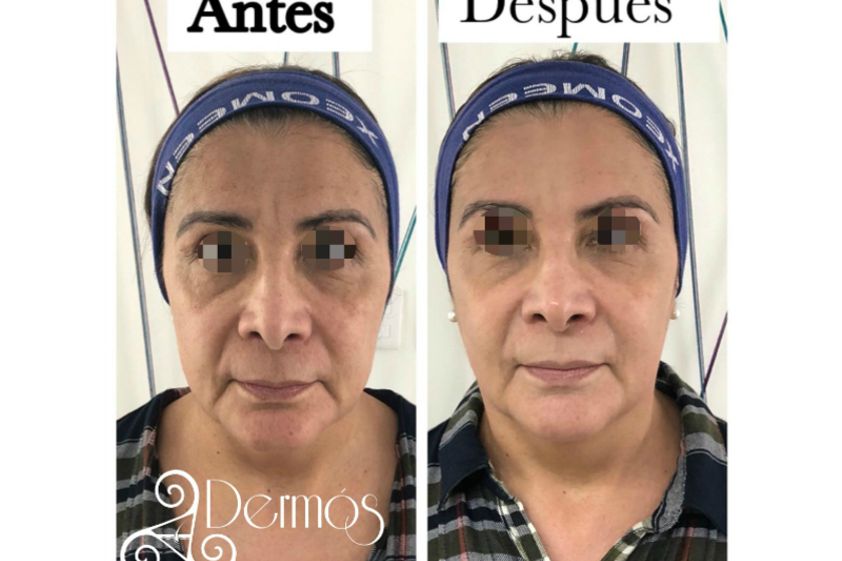 HIFU antes y después - 635454