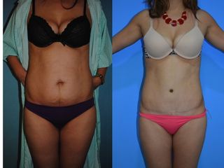 Antes y después de Abdominoplastia
