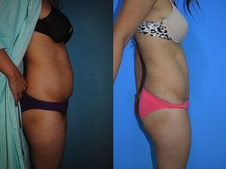 Antes y después de Cirugía de abdomen