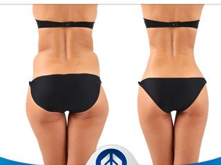Antes y después de lipoescultura