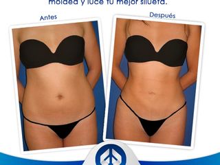 Antes y después de lipoescultura