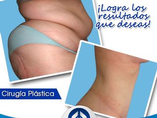 Antes y después de Abdominoplastia
