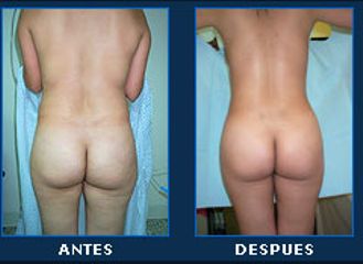Antes y después de lipoescultura
