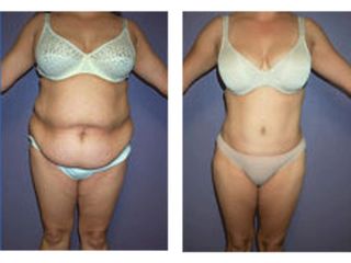Antes y después de Lipoescultura