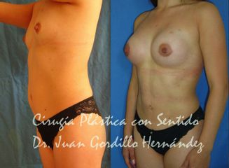 Antes y después de Lipo + aumento + gluteos