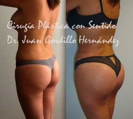 Antes y después de Aumento Glúteo con Grasa