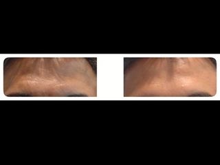 Antes y después de toxina botulínica